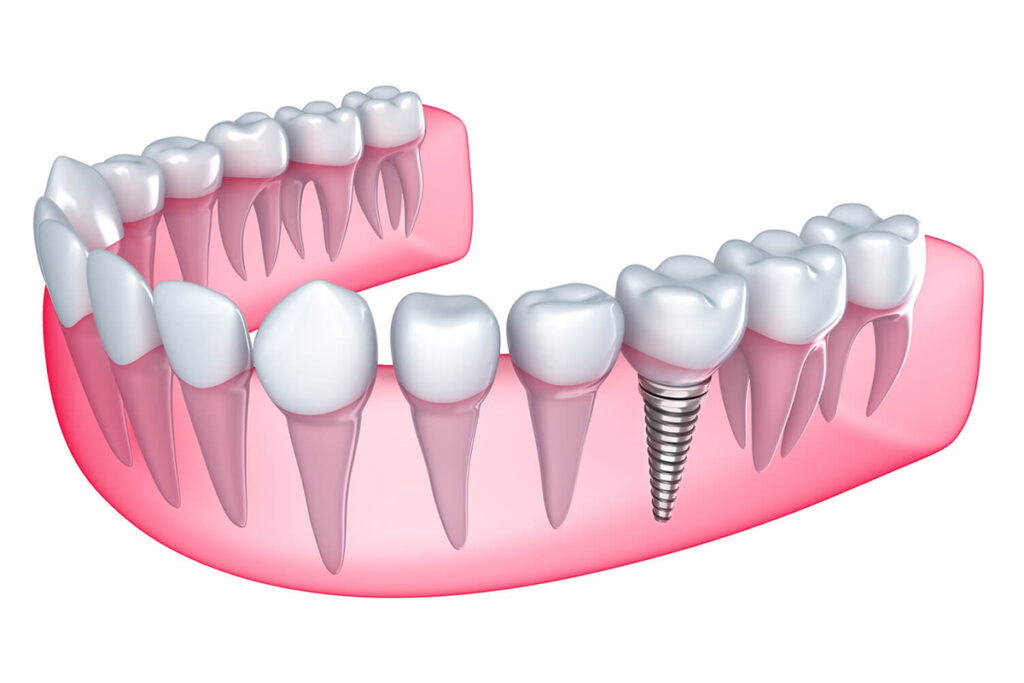 NHA KHOA DR.SMILECARE - CẤY GHÉP IMPLANT CÓ ĐIỂM VƯỢT TRỘI NÀO? 1 cay ghep Implant nha khoa link