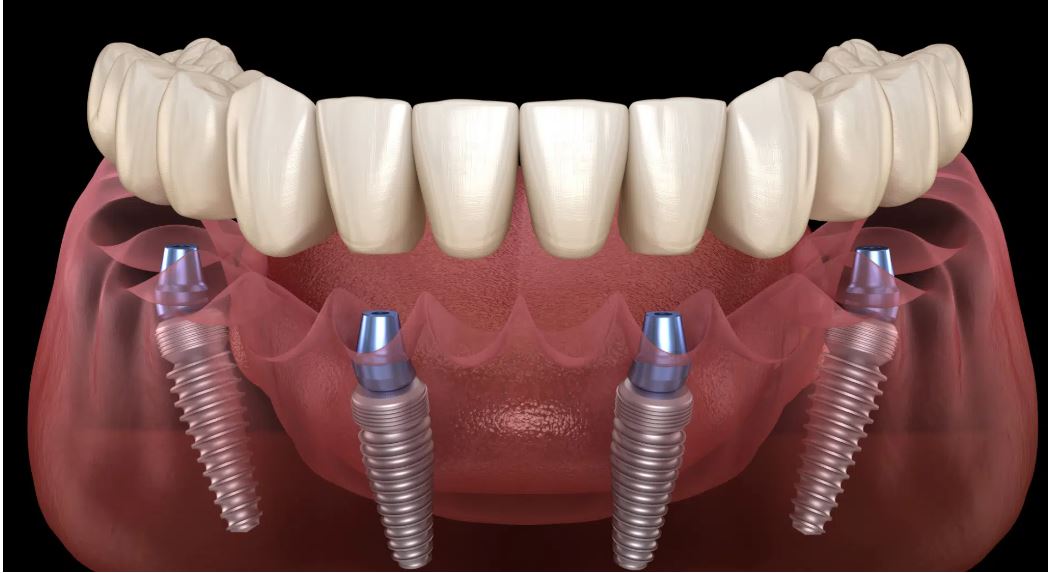 Implant all on 4 1