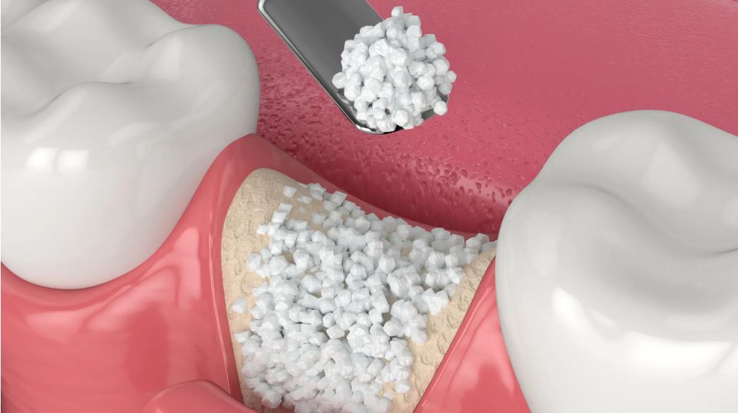 TRỒNG RĂNG IMPLANT ALL ON 4 - GIẢI PHÁP TỐI ƯU CHO NGƯỜI MẤT RĂNG TOÀN HÀM 2 Implant all on 4