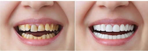 NÊN CẤY GHÉP IMPLANT HAY BỌC RĂNG SỨ? PHƯƠNG PHÁP NÀO HIỆU QUẢ HƠN 2 cay ghep implant hay boc su 2