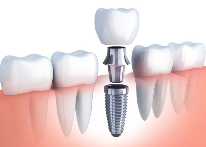 Các Giai Đoạn Hồi Phục Sau Khi Làm Implant