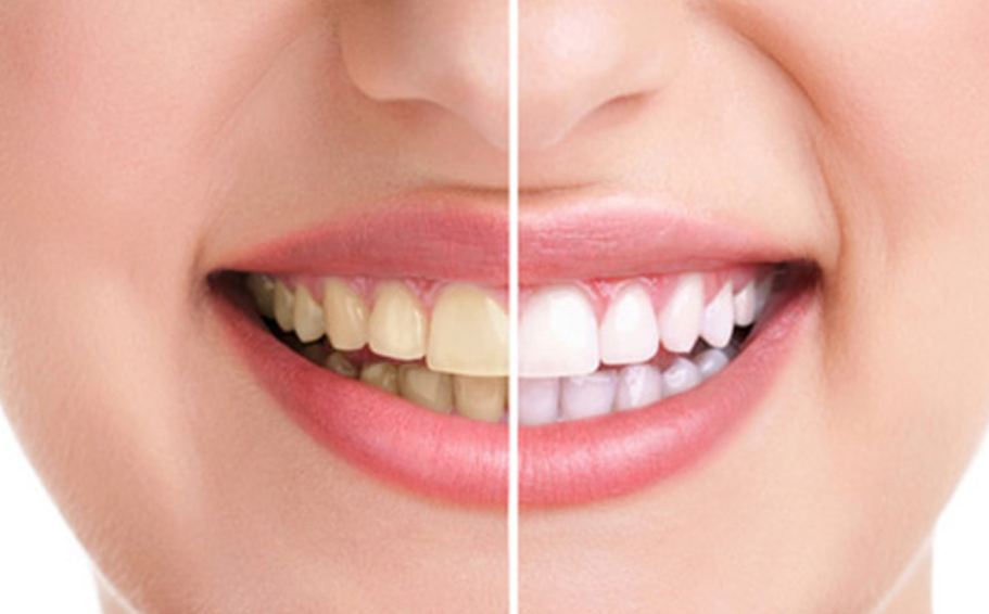 RĂNG SỨ BỊ Ố VÀNG PHẢI LÀM SAO