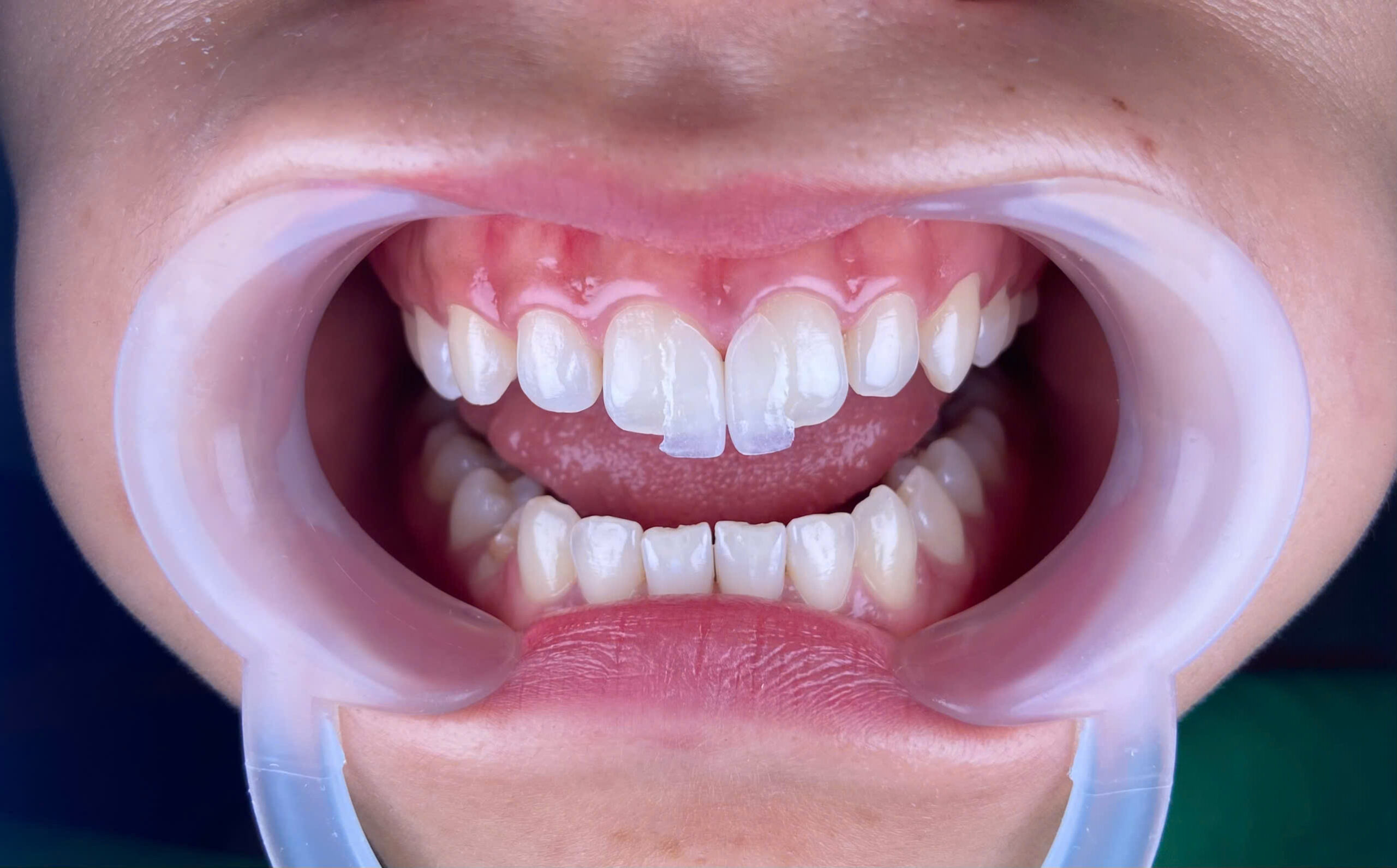 DÁN SỨ VENEER KHÔNG MÀI RĂNG: PHƯƠNG PHÁP PHỤC HÌNH HẠN CHẾ XÂM LẤN MANG LẠI HIỆU QUẢ CAO 2 z6045052689502 ddfcd20e8112cc77a9a7fd6e266154b4 scaled