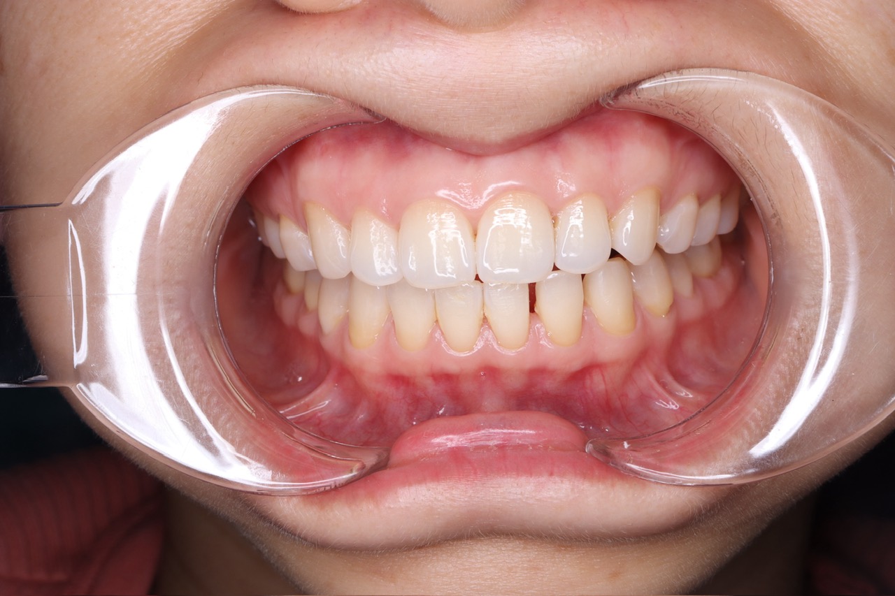 DÁN SỨ VENEER KHÔNG MÀI RĂNG: PHƯƠNG PHÁP PHỤC HÌNH HẠN CHẾ XÂM LẤN MANG LẠI HIỆU QUẢ CAO 3 z6048225289740 9d3d839ed56377e43679a4f12255fae6