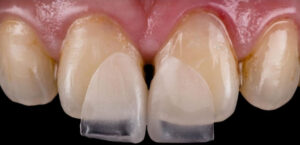 Non prep Veneer 1