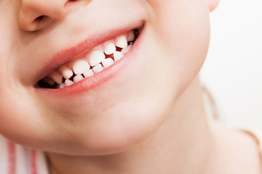 Khi nào bé cần trám răng và vật liệu nào an toàn cho trẻ?
