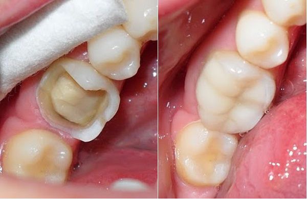 Khi nào bé cần trám răng và vật liệu nào an toàn cho trẻ?