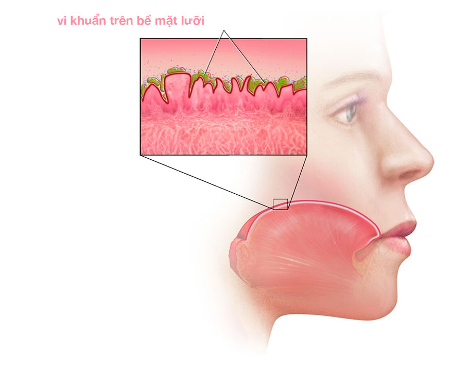 Những nguyên nhân phổ biến gây hôi miệng