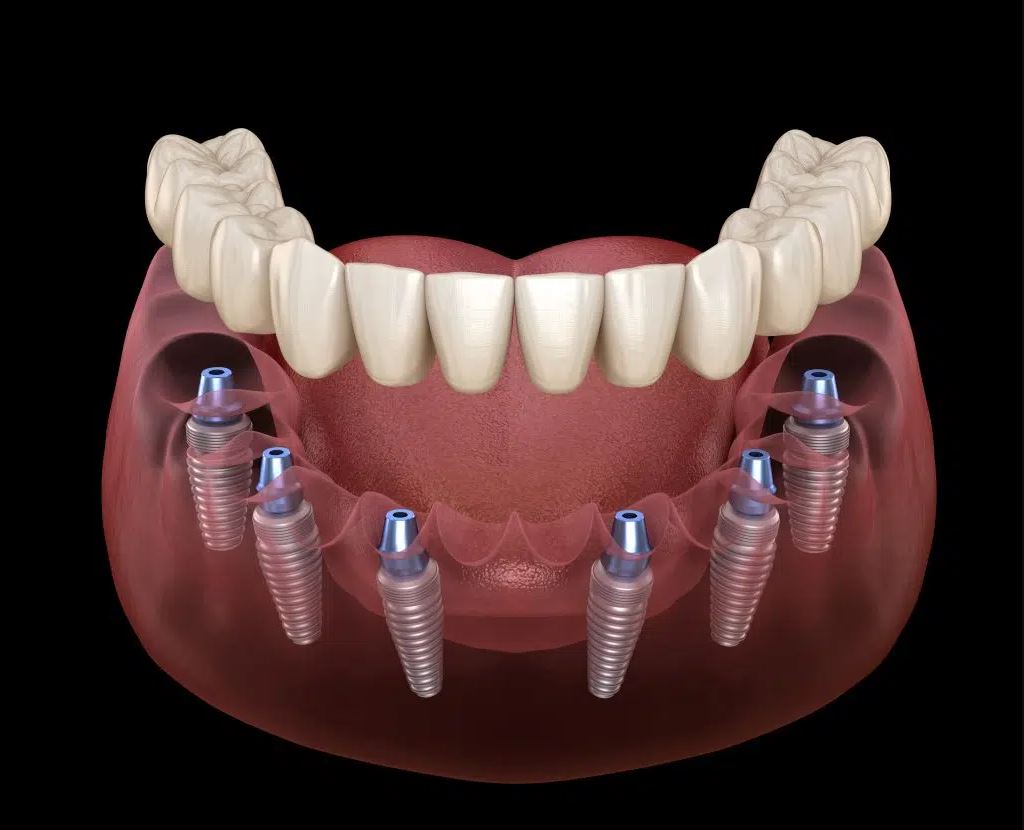Implant All on 6
