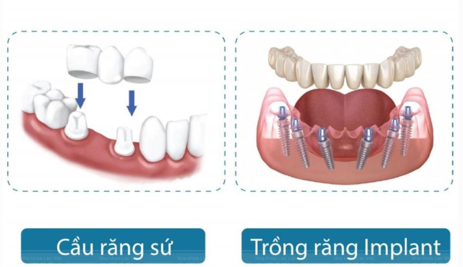cau rang su vs implant