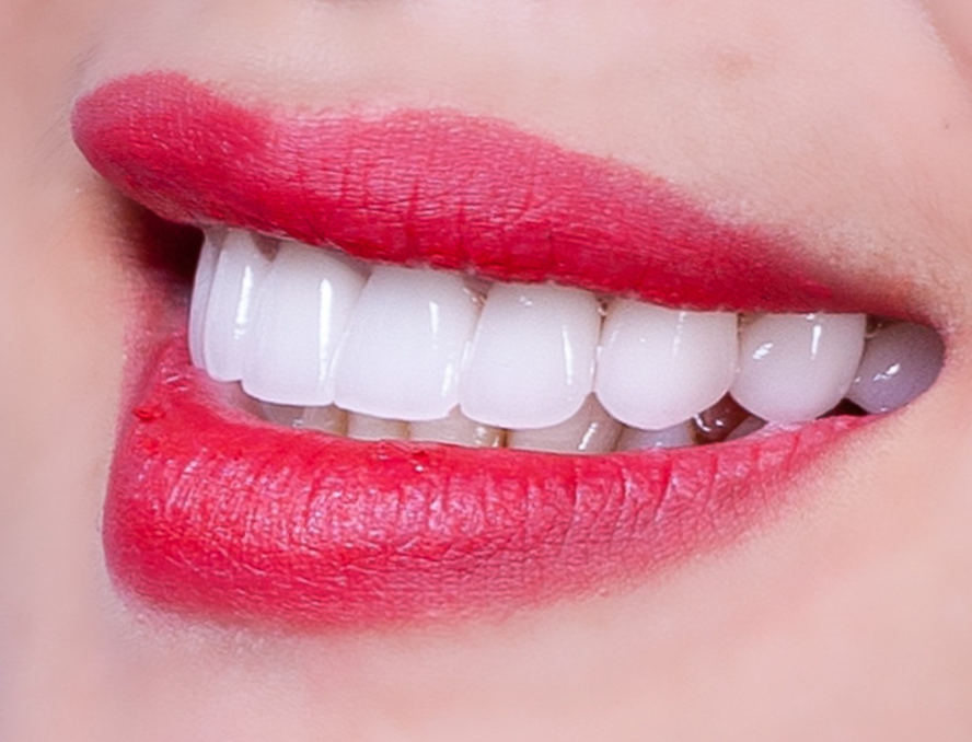 So sánh ưu và nhược điểm của các loại răng sứ hiện nay