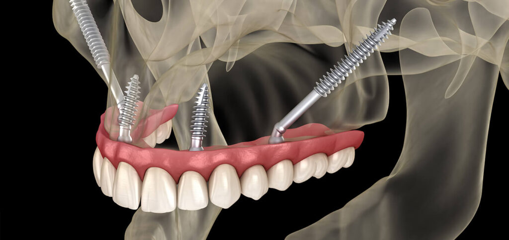 zygomatic dental implants L