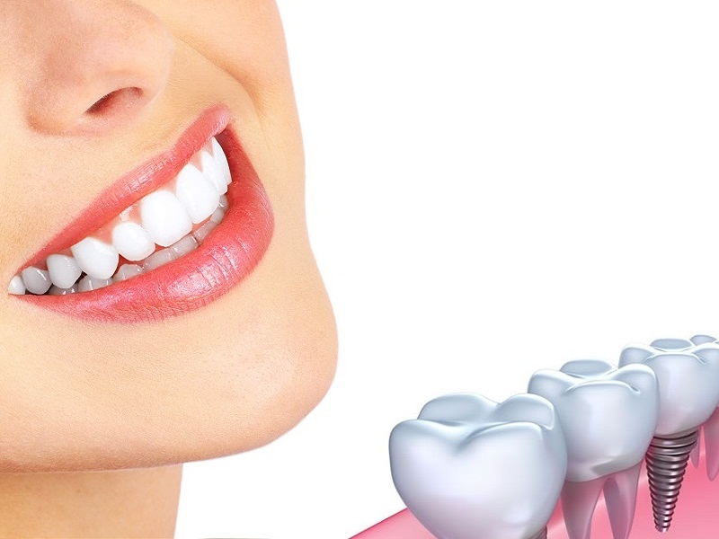 Các Giai Đoạn Hồi Phục Sau Khi Làm Implant
