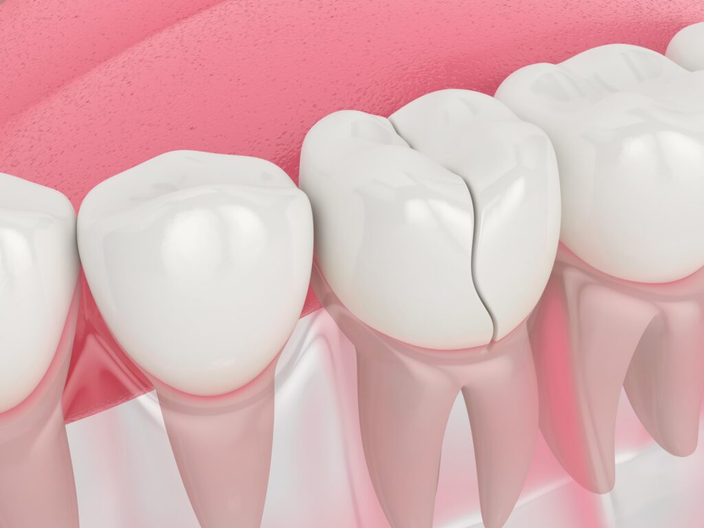NGUYÊN NHÂN KHIẾN RĂNG IMPLANT BỊ VỠ CÁCH CHĂM SÓC RĂNG IMPLANT CÓ ĐỘ BỀN LÂU DÀI