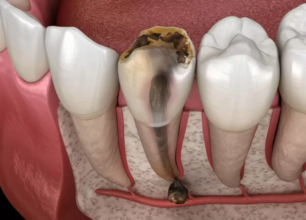 Mất 1 Răng: Chọn Implant, Cầu Răng Sứ Hay Hàm Tháo Lắp? 6 Mất 1 răng không trồng lại có sao không?