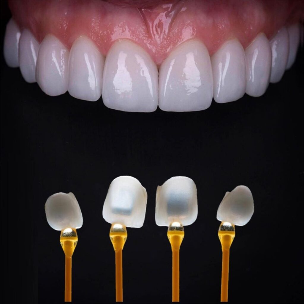 DÁN SỨ NON-PREP: PHƯƠNG PHÁP THẨM MỸ AN TOÀN, NHANH CHÓNG, MANG LẠI VẺ ĐẸP TỰ NHIÊN 15 DAN SU KHONG MAI RANG Thumbnail