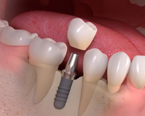 IMPLANT KHÔNG RẠCH LỢI: BƯỚC TIẾN MỚI TRONG NHA KHOA, HIỆU QUẢ CAO, AN TOÀN CHO KHÁCH HÀNG 1 implant khong rach loi buoc tien moi trong nha khoa hieu qua cao an toan cho khach hang