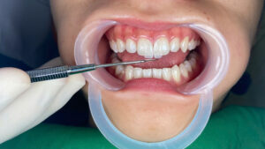 rang dan su thumbnail