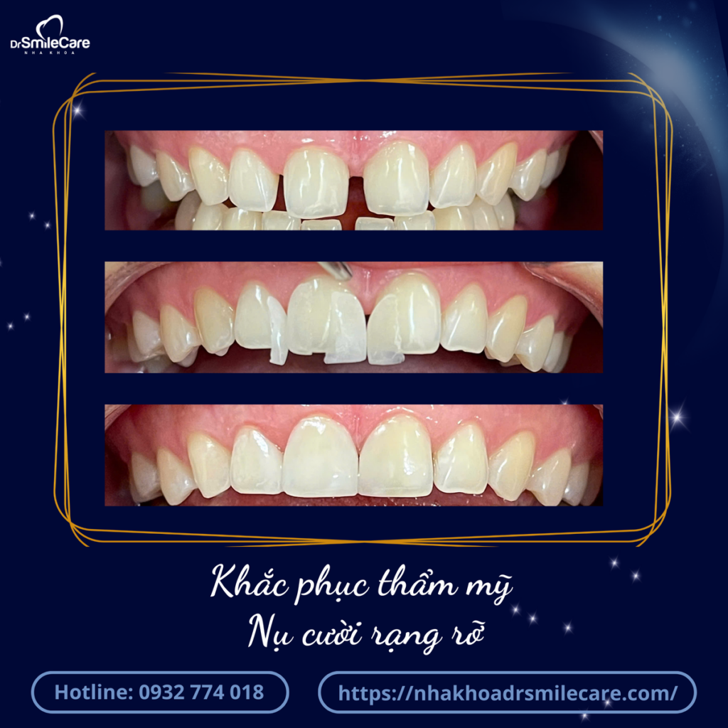 NON-PREP VENEER CÓ BỀN KHÔNG? SỰ KHÁC BIỆT GIỮA DÁN SỨ NON-PREP VÀ DÁN SỨ TRUYỀN THỐNG 8 3 1