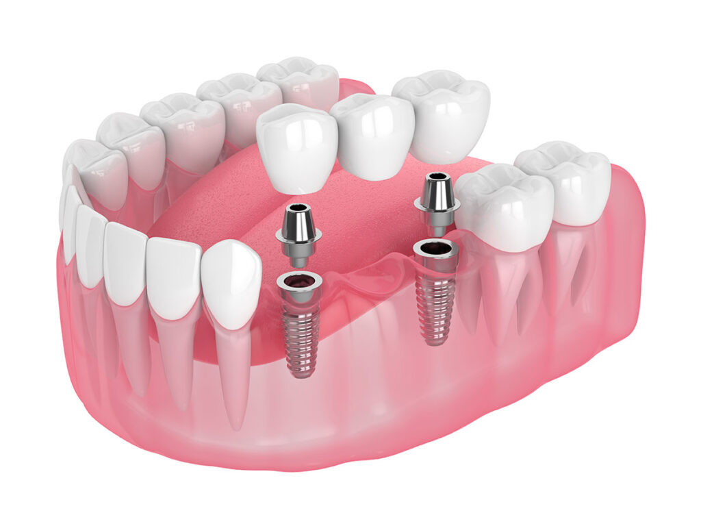 CÁC LOẠI TRỤ IMPLANT TỐT NHẤT TẠI NHA KHOA DR.SMILECARE – GIẢI PHÁP PHỤC HỒI RĂNG TOÀN DIỆN 1 tru implant tot nhat