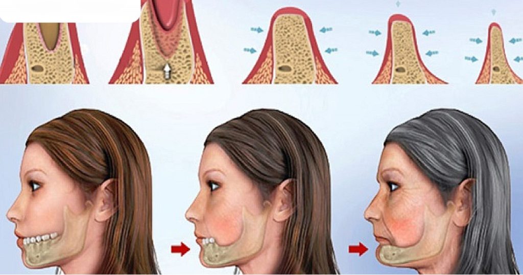 Bảng mức độ tiêu xương hàm theo thời gian mất răng