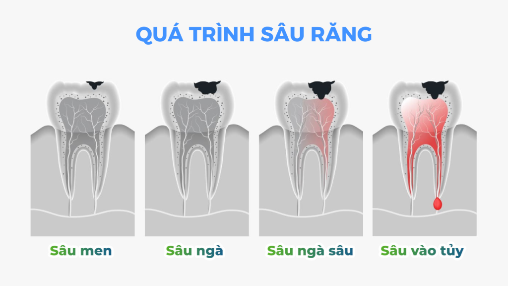 Sâu răng tiến triển qua bao nhiêu giai đoạn