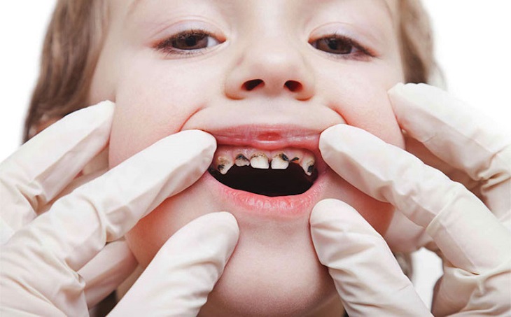Vì sao cha mẹ hay chủ quan khi con bị sâu răng sữa?