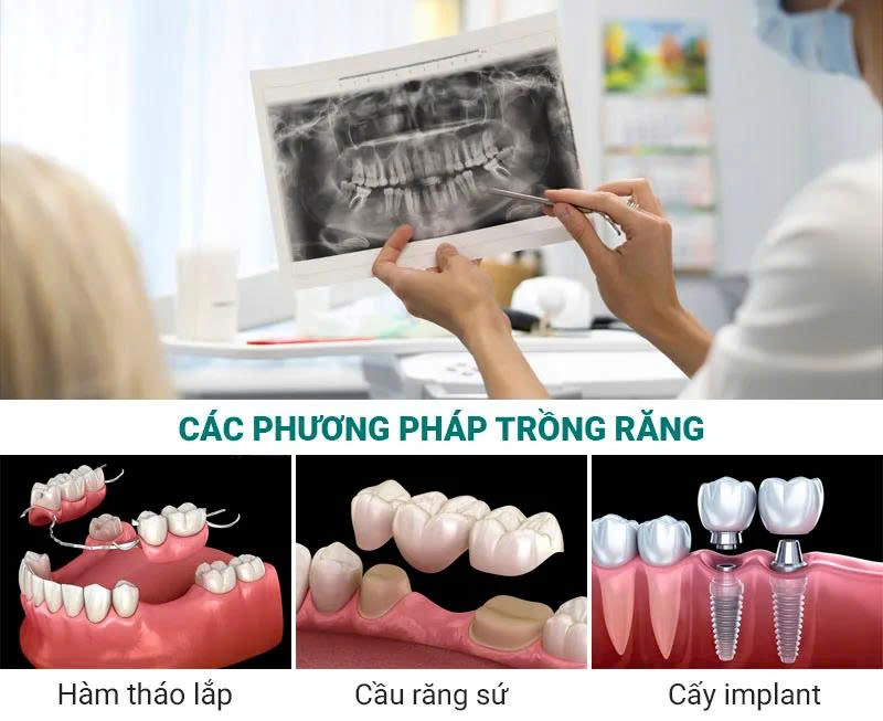 So Sánh Ba Phương Pháp Phục Hình Răng Cửa