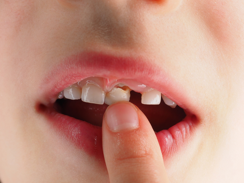 Vì sao răng sữa cần được thay thế?