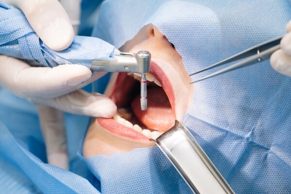 Quy trình trồng Implant tại Dr.SmileCare