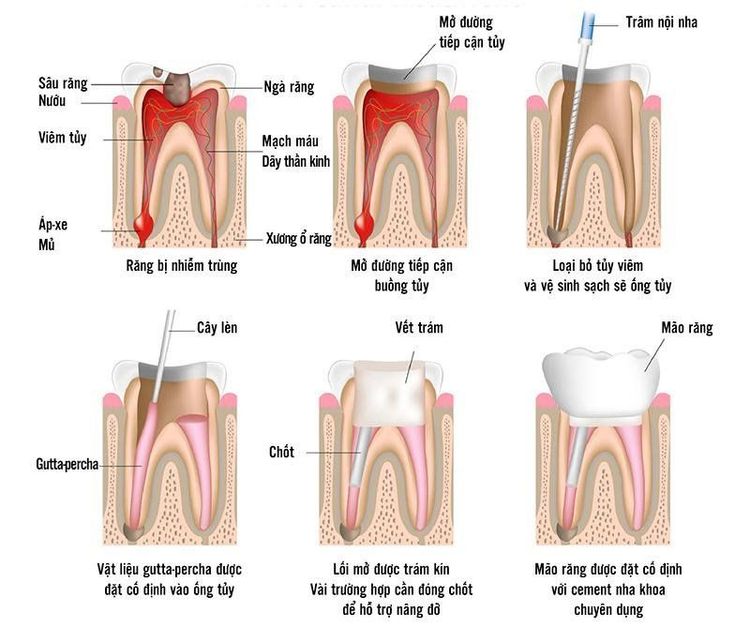 Chữa tủy răng là gì và khi nào cần thực hiện