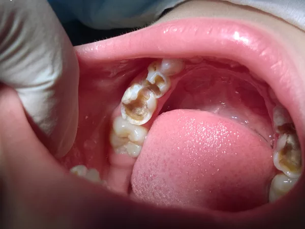 Khi nào nên trám răng sữa cho bé?