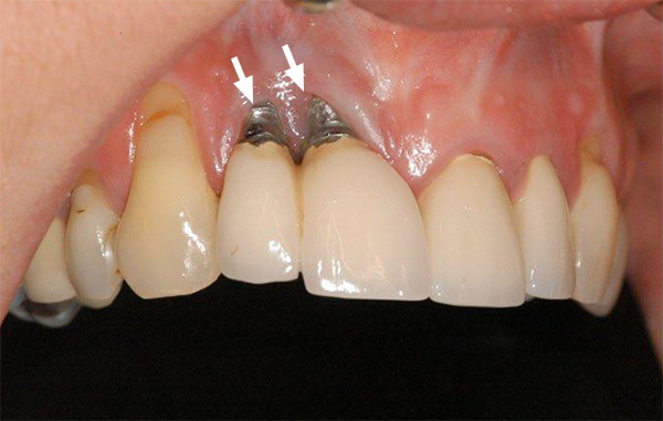 Tỷ lệ Implant bị đào thải, thất bại là bao nhiêu?