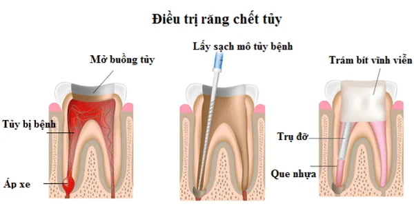 Răng Đã Lấy Tủy Có Cần Bọc Sứ Không? Khi Nào Nên Bọc? 4 Vì sao răng đã lấy tủy dễ nứt vỡ hơn răng bình thường?