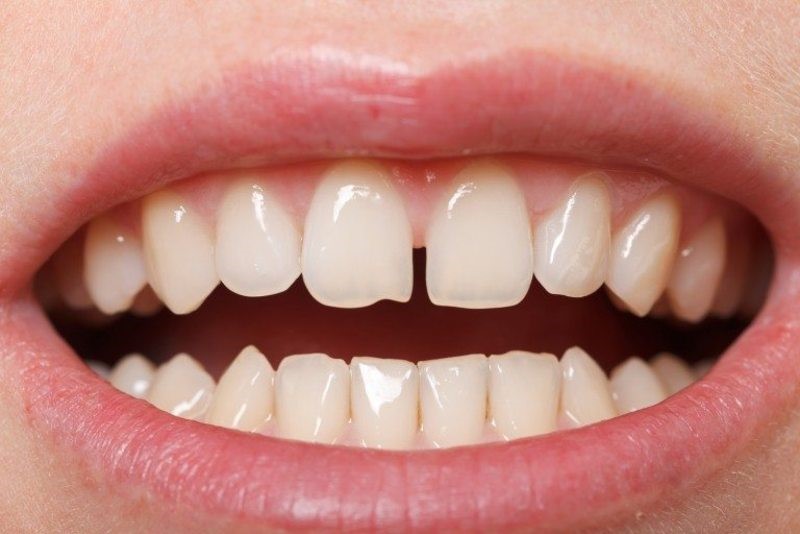 Răng thưa ngày càng hở ra: dấu hiệu cần khám sớm