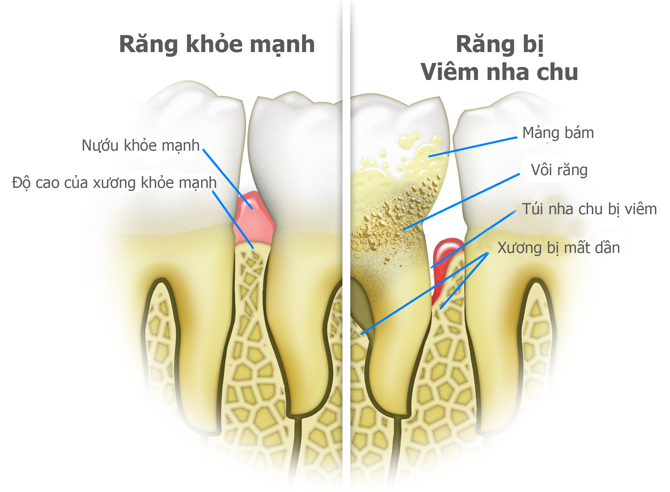 Viêm nha chu là gì và vì sao khiến răng lung lay?
